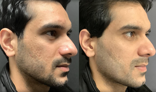 acne scarring treatment before after oakville mississauga